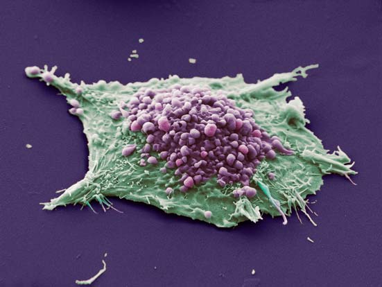 Раковые клетки сопротивляются лекарствам без мутаций